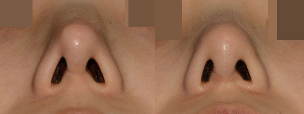 비중격연골코성형 비중격코성형 로코코성형외과