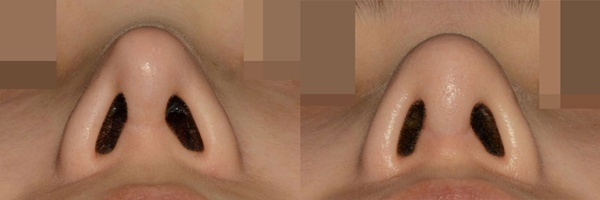 비중격연골코성형 비중격코성형 로코코성형외과